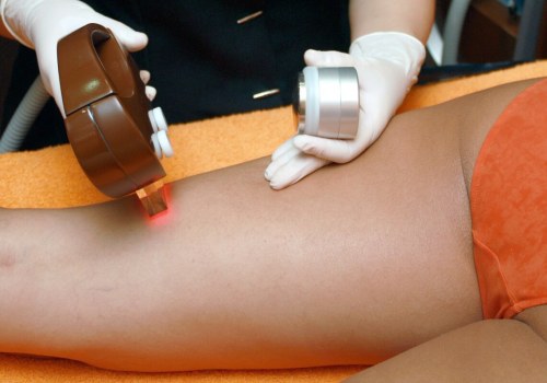 Does laser hair removal affect chances of pregnancy?